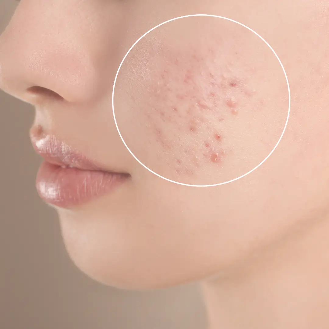 tratamiento cicatrices post acne